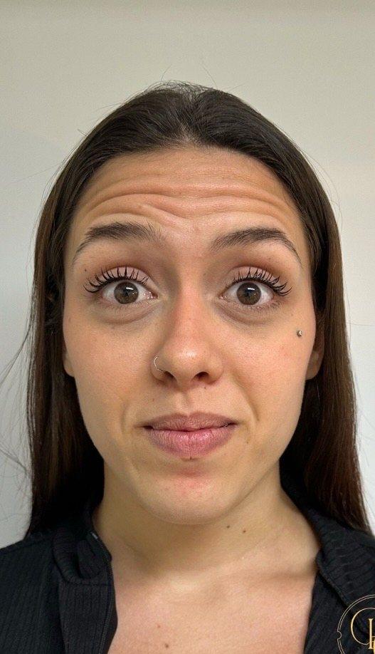 Antes — Harmonização facial