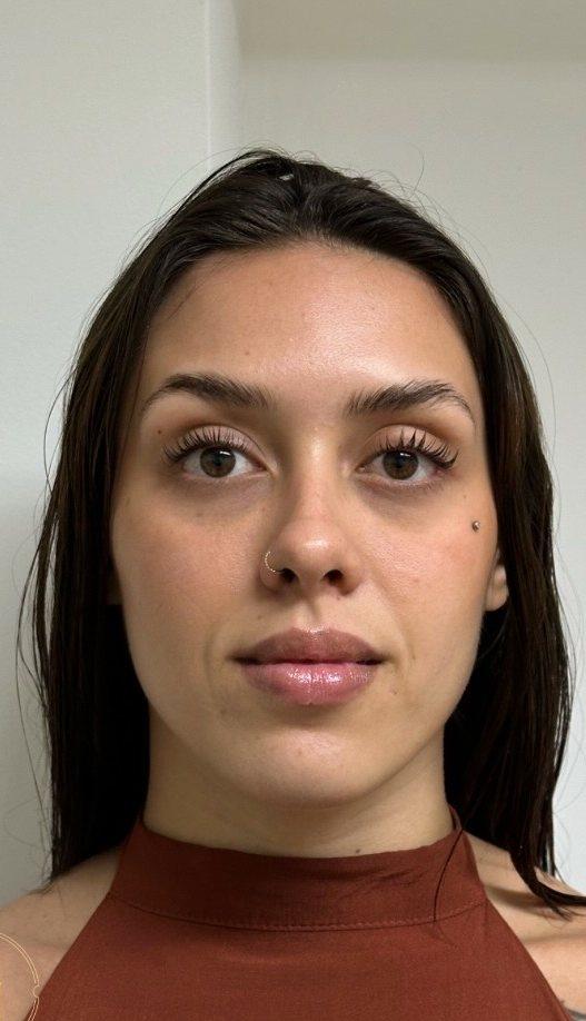 Depois — Harmonização facial