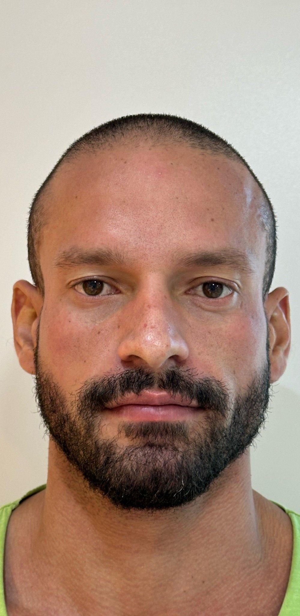 Antes — Harmonização facial