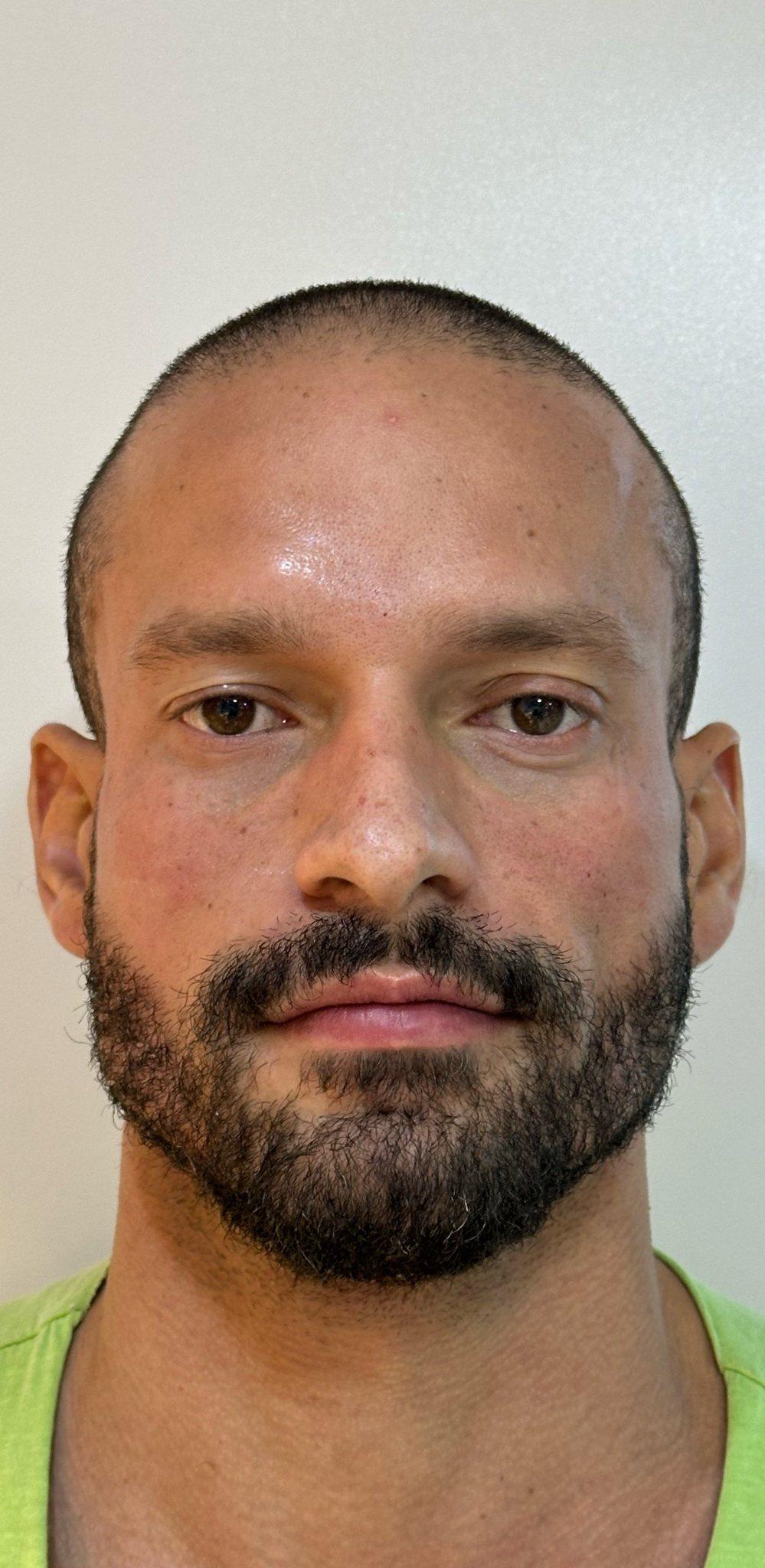 Depois — Harmonização facial
