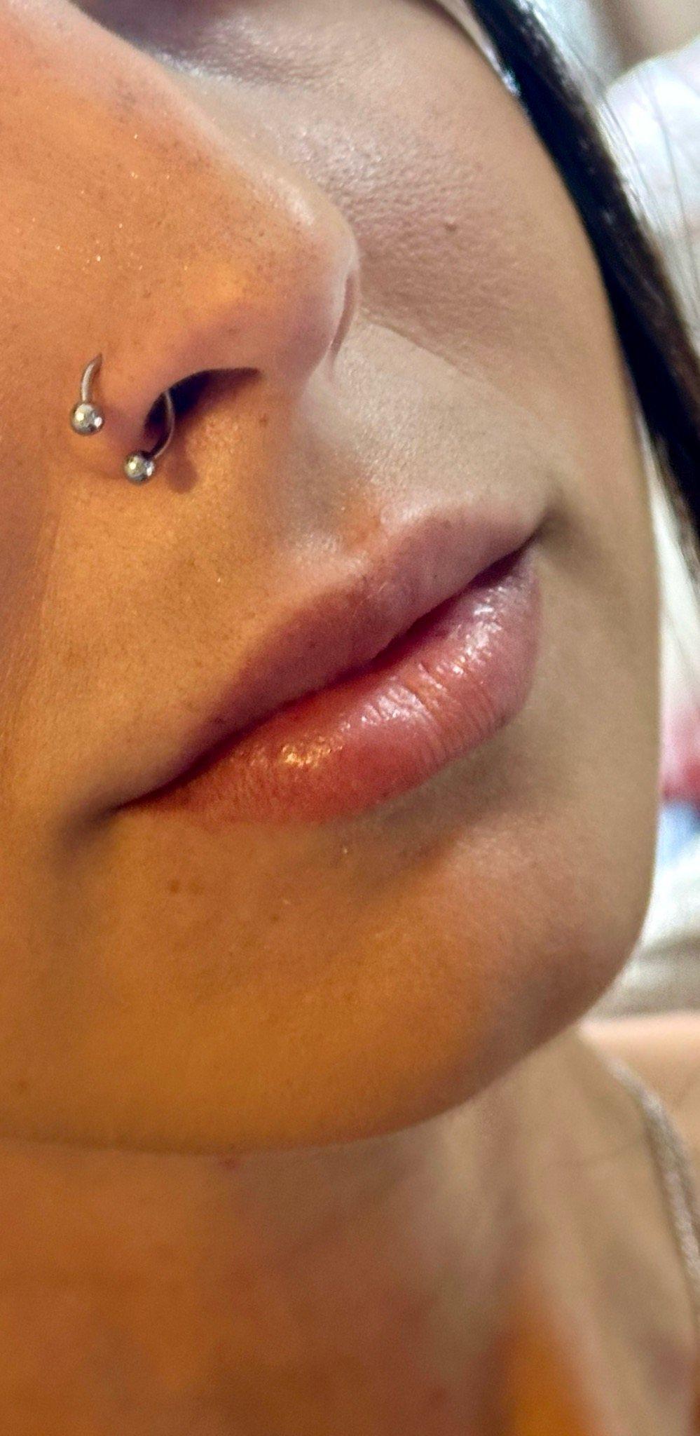 Antes — Preenchimento labial