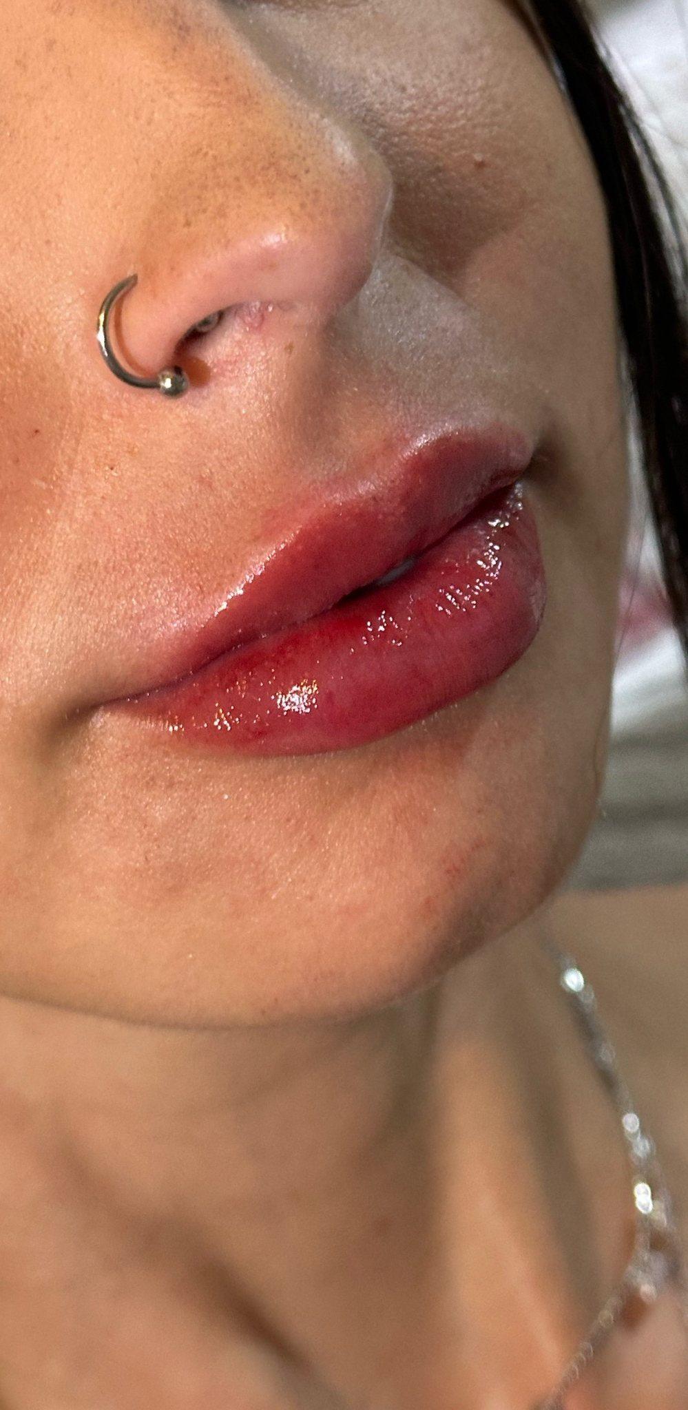 Depois — Preenchimento labial