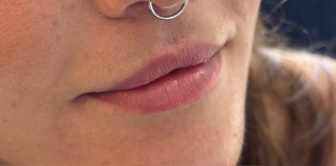 Antes — Preenchimento labial