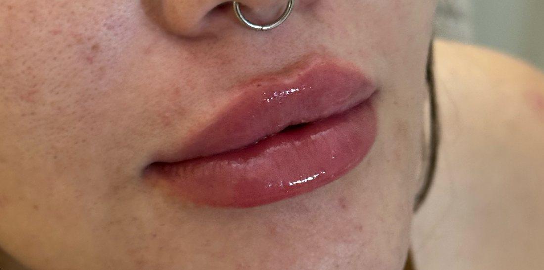 Depois — Preenchimento labial